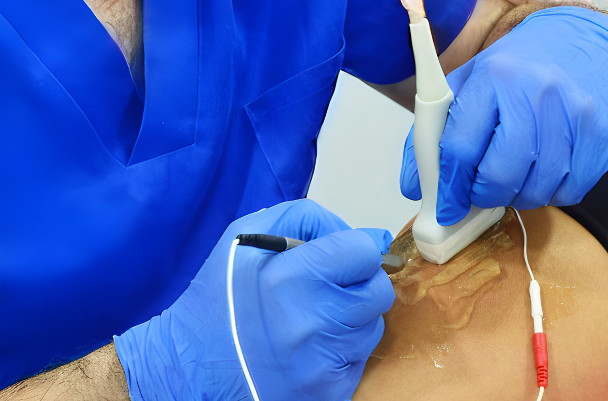 Webinar: Fisioterapia Invasiva en Lesiones Musculares de Deportistas