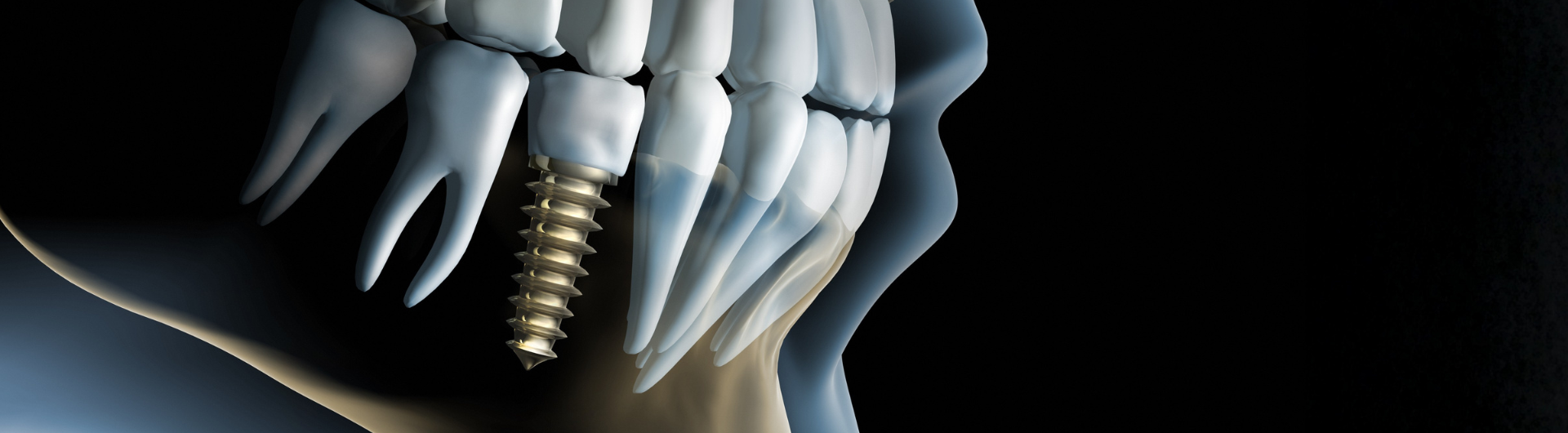 Programa de Especialización en Implantología Buco Maxilofacial | Uandes
