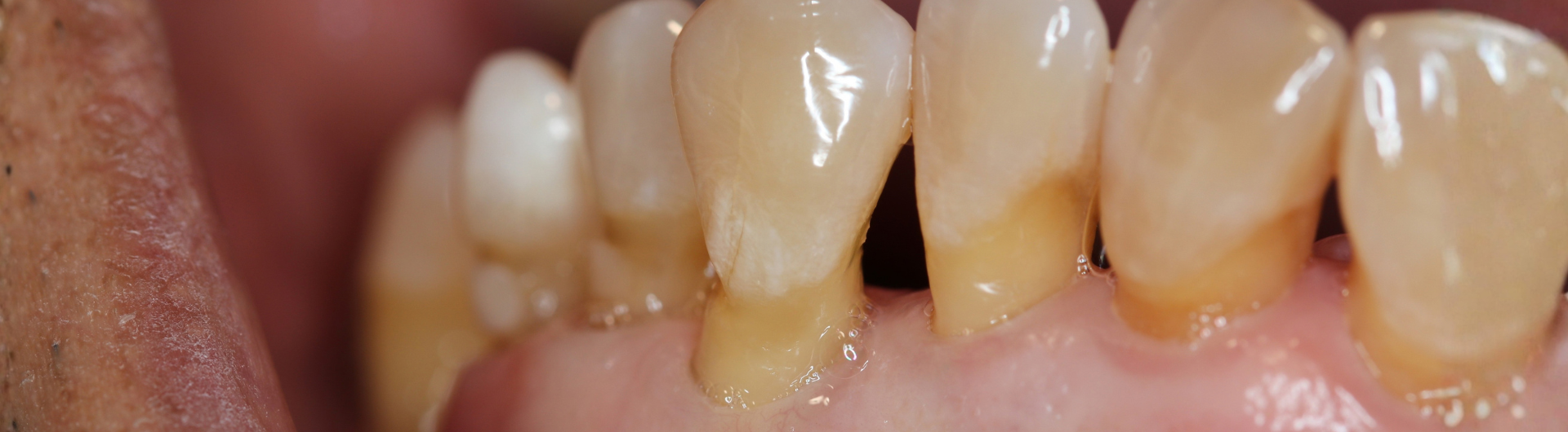 Diplomado en Cirugía Plástica y Reconstructiva Periodontal e Implantológica