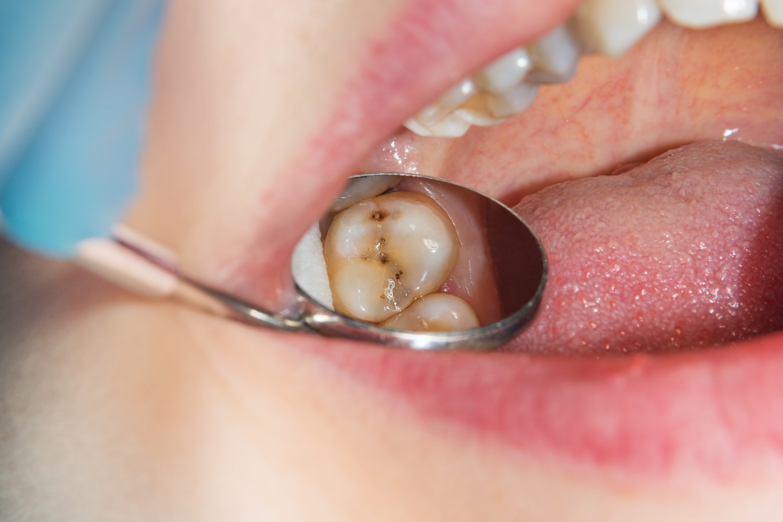 Curso de Calibración Teórica Práctica en Criterio de Detección de Caries ICDAS-ICCMS